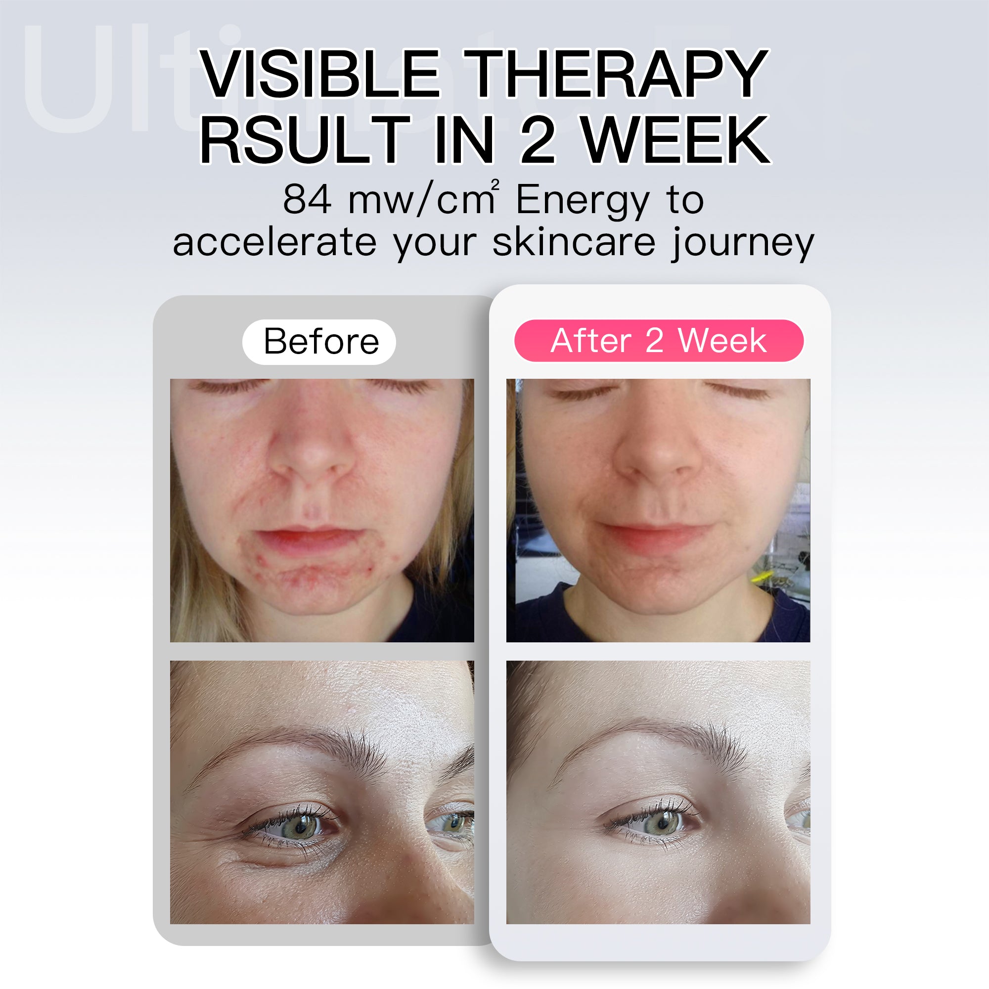 Iborria MN1 LED Light Therapy Face and Neck Mask